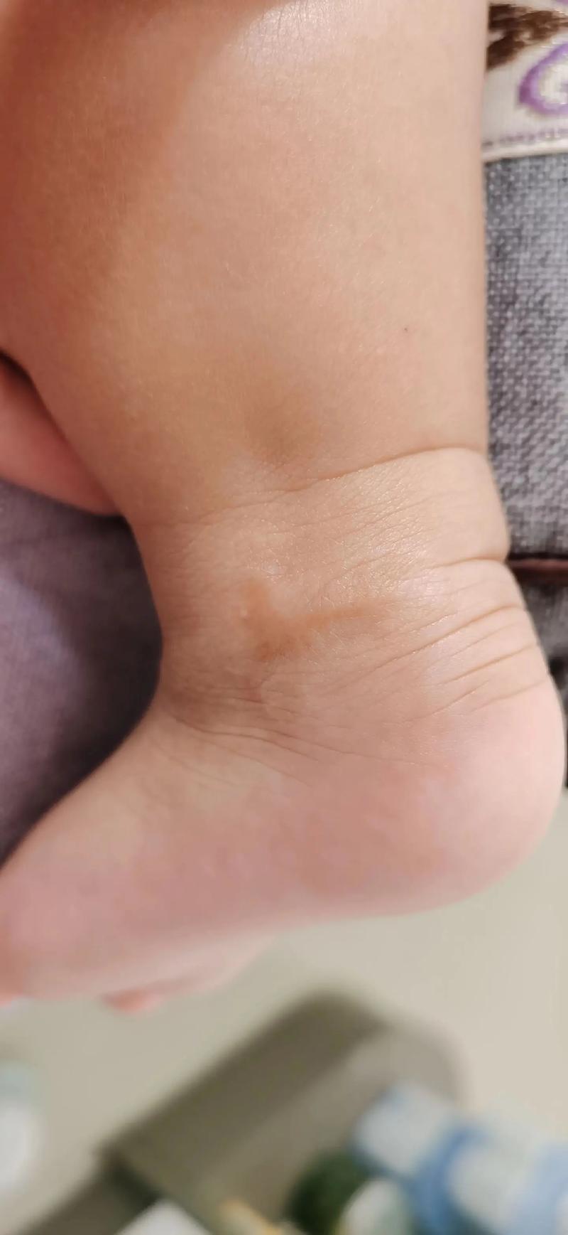 新生儿足跟血苯丙酮高是遗传病吗？需要如何干预治疗？-第3张图片-郑州医学网