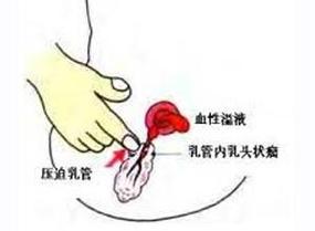 孕期乳头出现分泌物结痂是正常现象吗？会对哺乳有影响吗？-第3张图片-郑州医学网