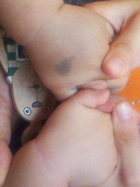 新生儿手背青胎记是先天形成还是后天因素导致？需要干预治疗吗？-第1张图片-郑州医学网