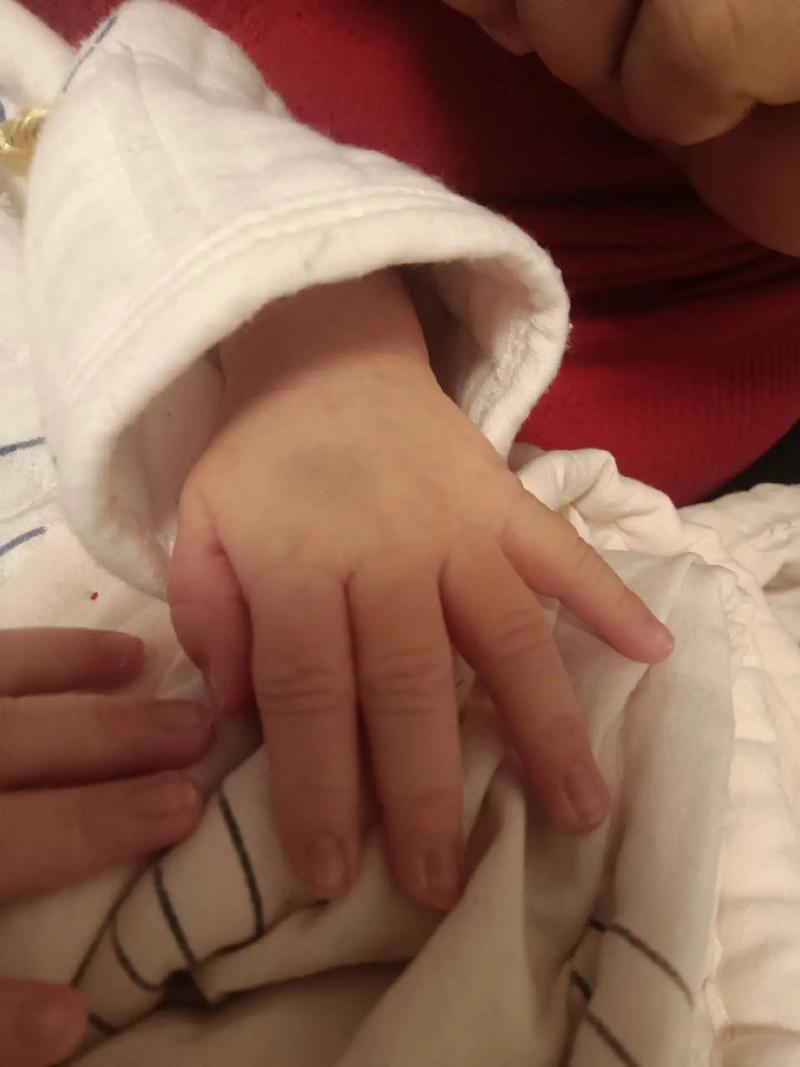 新生儿手背青胎记是先天形成还是后天因素导致？需要干预治疗吗？-第2张图片-郑州医学网