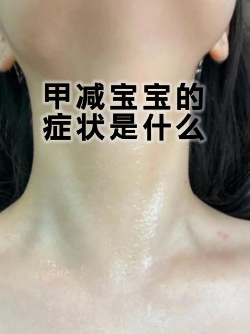 妈妈甲减会遗传给新生儿吗？孕期如何降低宝宝患病风险？-第2张图片-郑州医学网