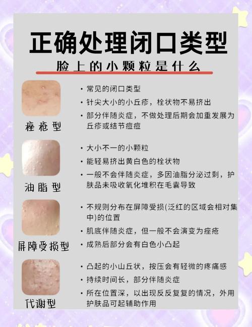 孕期长闭口粉刺反反复复,到底该怎么安全护理才能消?-第1张图片-郑州医学网 孕期长闭口粉刺反反复复,到底该怎么安全护理才能消?-第1张图片-郑州医学网