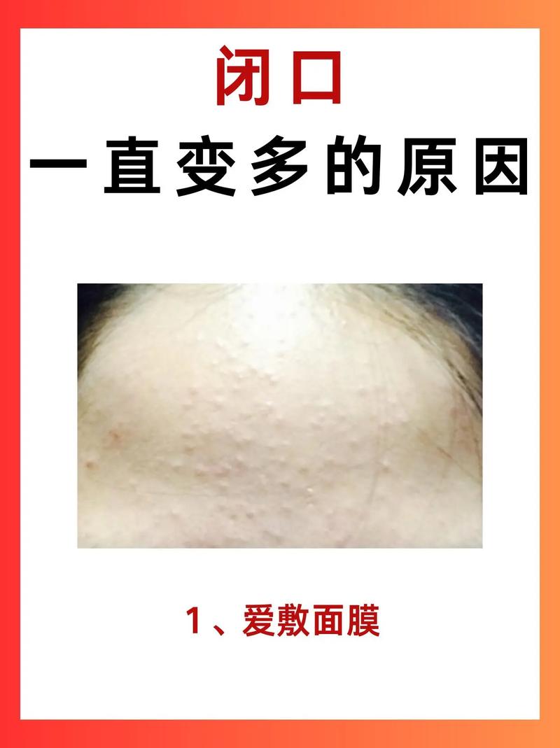 孕期长闭口粉刺反反复复,到底该怎么安全护理才能消?-第3张图片-郑州医学网 孕期长闭口粉刺反反复复,到底该怎么安全护理才能消?-第3张图片-郑州医学网