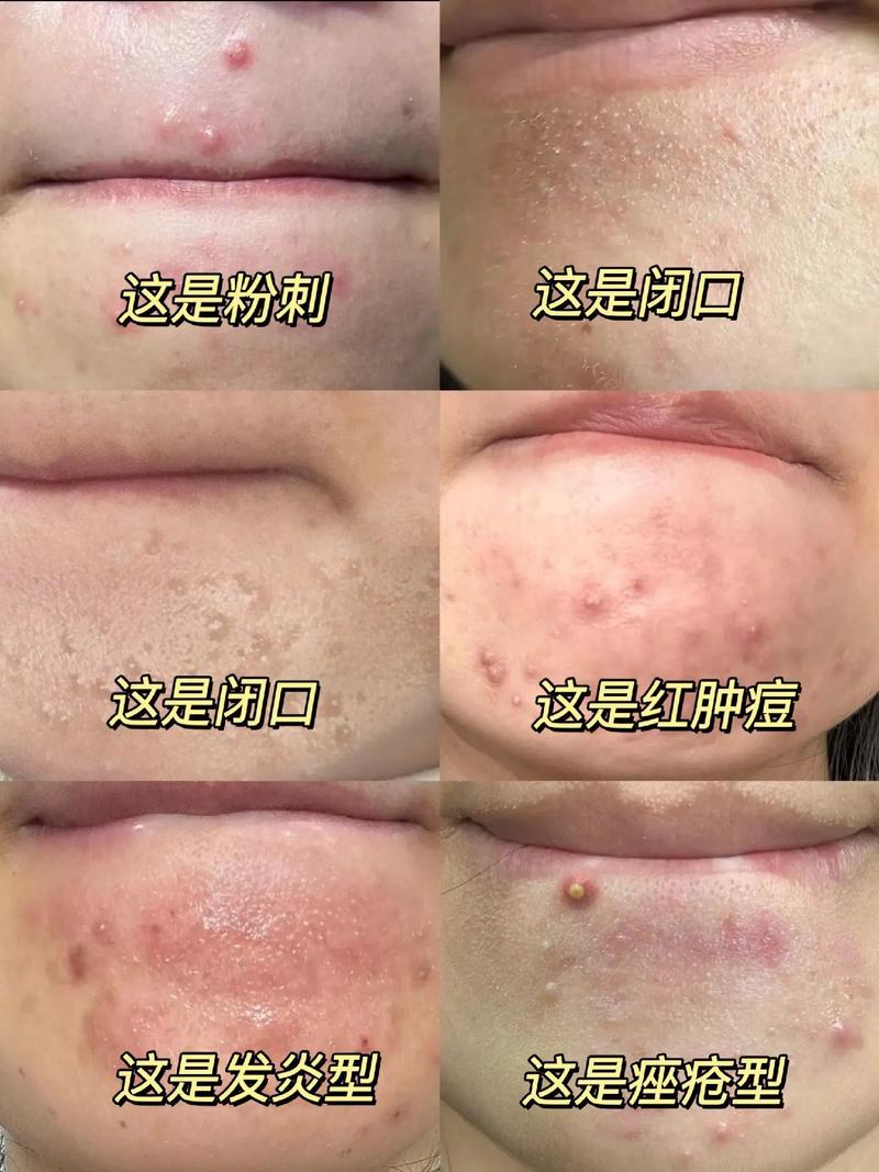 孕期长闭口粉刺反反复复,到底该怎么安全护理才能消?-第2张图片-郑州医学网 孕期长闭口粉刺反反复复,到底该怎么安全护理才能消?-第2张图片-郑州医学网