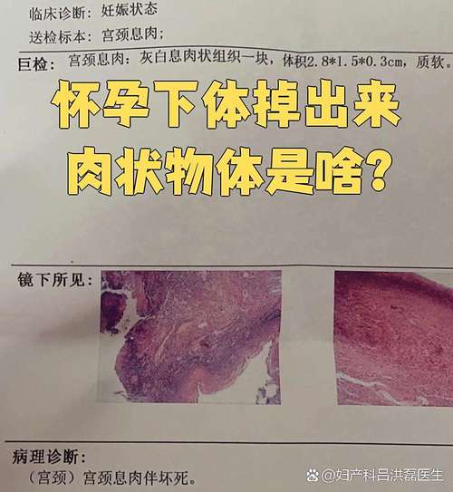 孕期下面有坨肉堵住是何原因?会对分娩造成影响吗?-第1张图片-郑州医学网 孕期下面有坨肉堵住是何原因?会对分娩造成影响吗?-第1张图片-郑州医学网