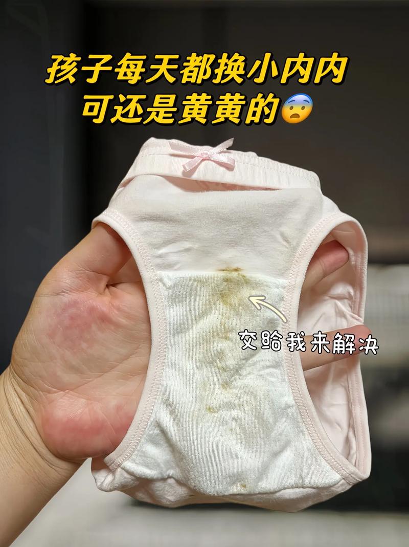 孕期内裤上的黄渍为何总洗不掉？是正常分泌物还是异常信号？-第1张图片-郑州医学网
