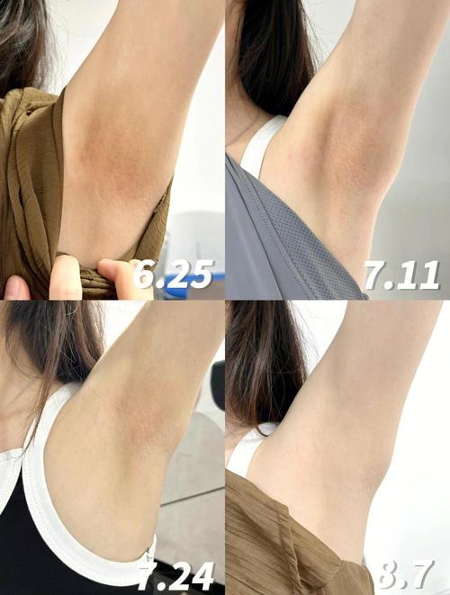 怀孕期间腋下变黑是什么原因?图片显示正常吗?需要担心吗?-第2张图片-郑州医学网 怀孕期间腋下变黑是什么原因?图片显示正常吗?需要担心吗?-第2张图片-郑州医学网