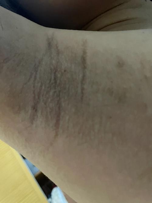 怀孕期间腋下变黑是什么原因?图片显示正常吗?需要担心吗?-第1张图片-郑州医学网 怀孕期间腋下变黑是什么原因?图片显示正常吗?需要担心吗?-第1张图片-郑州医学网