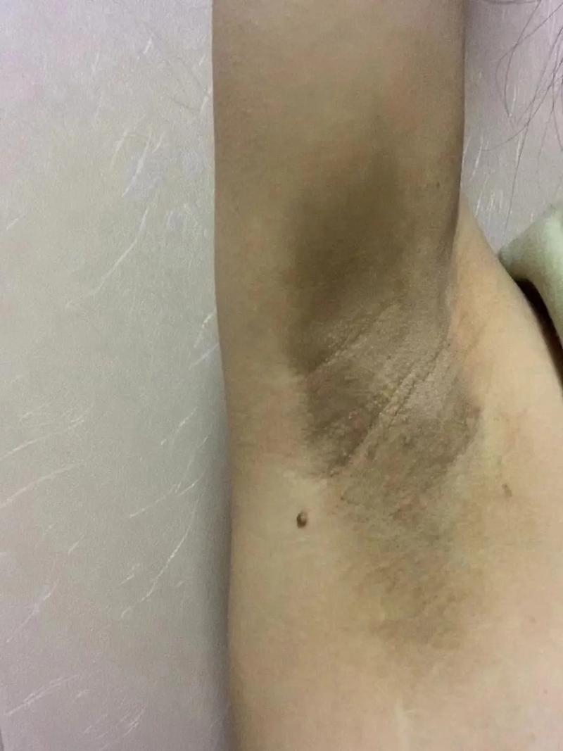 怀孕期间腋下变黑是什么原因？图片显示正常吗？需要担心吗？-第3张图片-郑州医学网