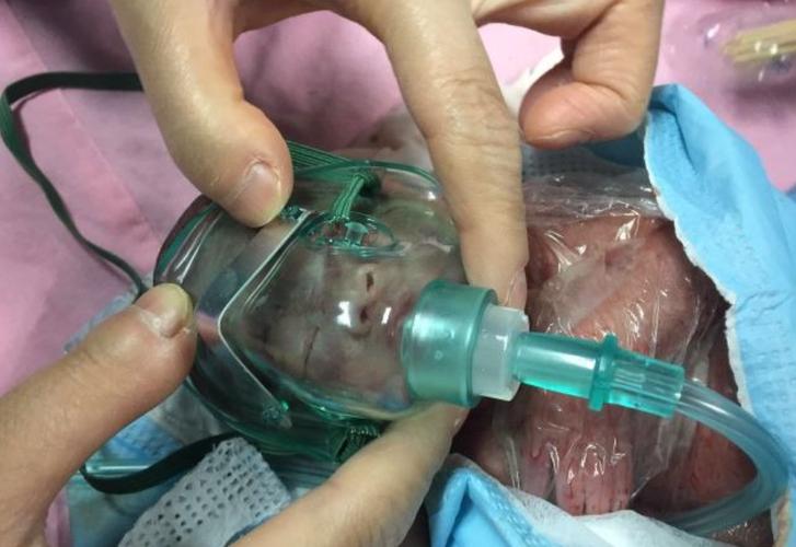 新生儿头上软包穿刺抽液是必要治疗还是存在风险？-第1张图片-郑州医学网