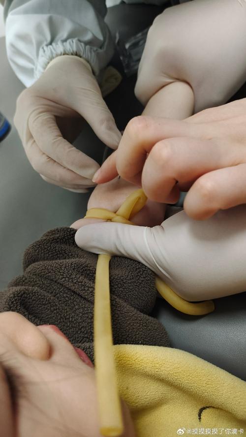 新生儿头上软包穿刺抽液是必要治疗还是存在风险？-第3张图片-郑州医学网