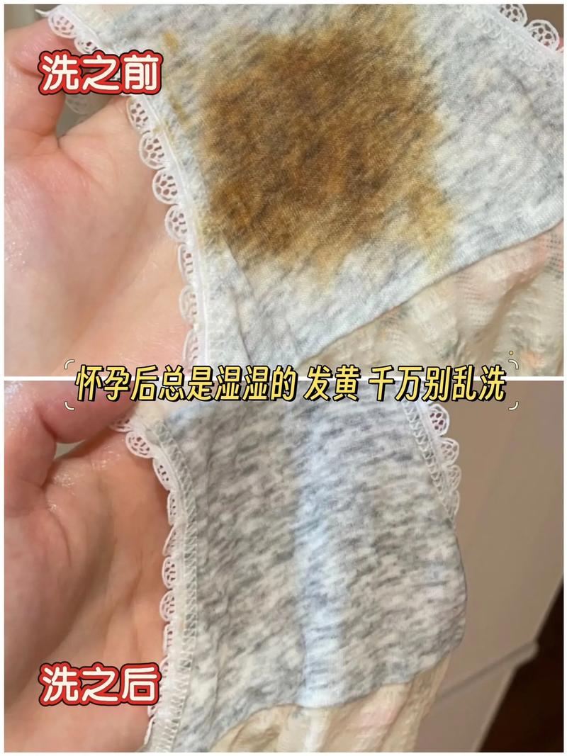 孕期白带呈现黄绿色真的是怀男孩的信号吗？这种说法有科学依据吗？-第3张图片-郑州医学网