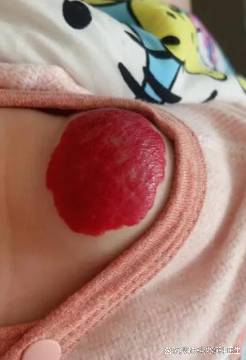 新生儿血管瘤怎么判断？家长需掌握哪些典型特征与观察要点？-第3张图片-郑州医学网