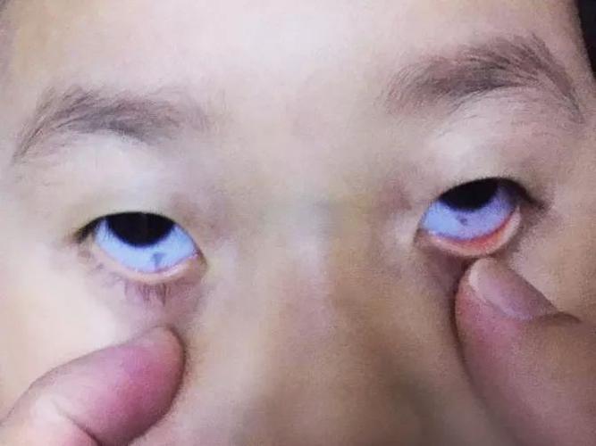 新生儿黑眼球发灰是正常现象还是异常信号？需警惕哪些眼部问题？-第2张图片-郑州医学网