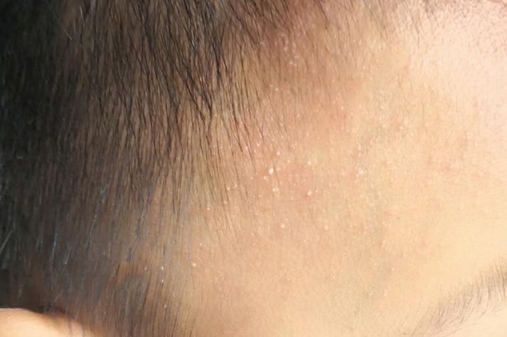 新生儿脸上长白色粉刺图片显示的是正常现象吗?需要如何护理和区分其他皮肤问题?-第1张图片-郑州医学网 新生儿脸上长白色粉刺图片显示的是正常现象吗?需要如何护理和区分其他皮肤问题?-第1张图片-郑州医学网