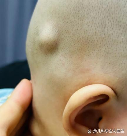 新生儿头上突然出现硬包是正常现象还是疾病信号？需要立即就医吗？-第1张图片-郑州医学网