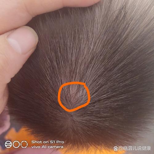 新生儿头上突然出现硬包是正常现象还是疾病信号？需要立即就医吗？-第2张图片-郑州医学网