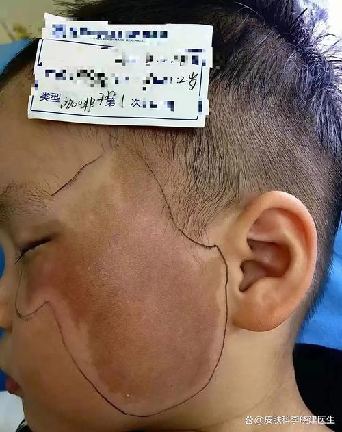 新生儿身上的咖啡斑会随着年龄增长自行消失吗?需要干预吗?-第1张图片-郑州医学网 新生儿身上的咖啡斑会随着年龄增长自行消失吗?需要干预吗?-第1张图片-郑州医学网