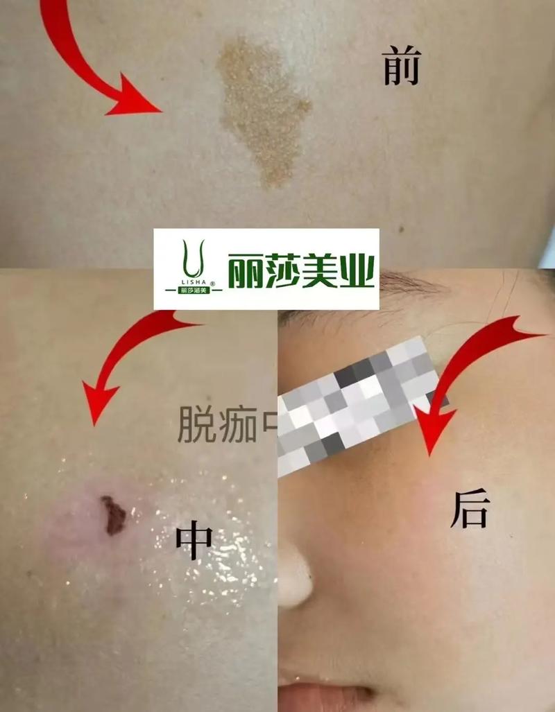 新生儿身上的咖啡斑会随着年龄增长自行消失吗?需要干预吗?-第2张图片-郑州医学网 新生儿身上的咖啡斑会随着年龄增长自行消失吗?需要干预吗?-第2张图片-郑州医学网