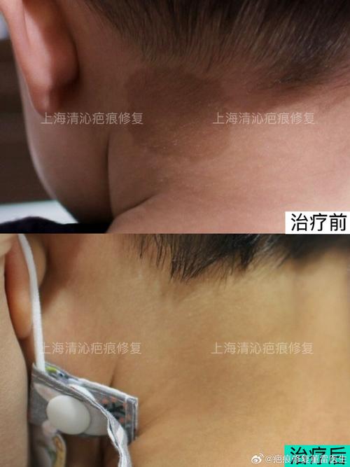 新生儿身上的咖啡斑会随着年龄增长自行消失吗?需要干预吗?-第3张图片-郑州医学网 新生儿身上的咖啡斑会随着年龄增长自行消失吗?需要干预吗?-第3张图片-郑州医学网