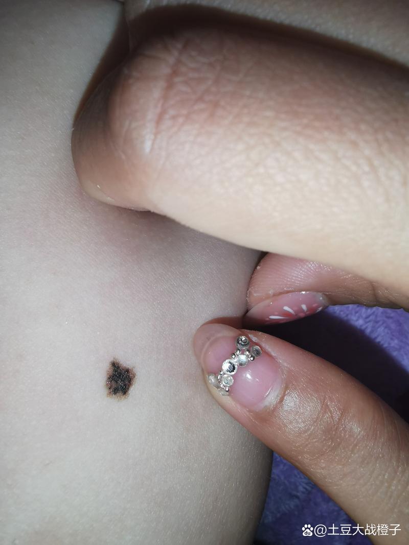 新生儿出生就带黑痣,是先天印记还是健康预警?-第1张图片-郑州医学网 新生儿出生就带黑痣,是先天印记还是健康预警?-第1张图片-郑州医学网