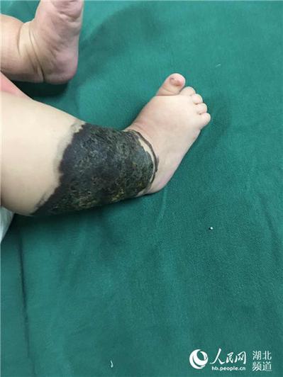 新生儿出生就带黑痣,是先天印记还是健康预警?-第3张图片-郑州医学网 新生儿出生就带黑痣,是先天印记还是健康预警?-第3张图片-郑州医学网