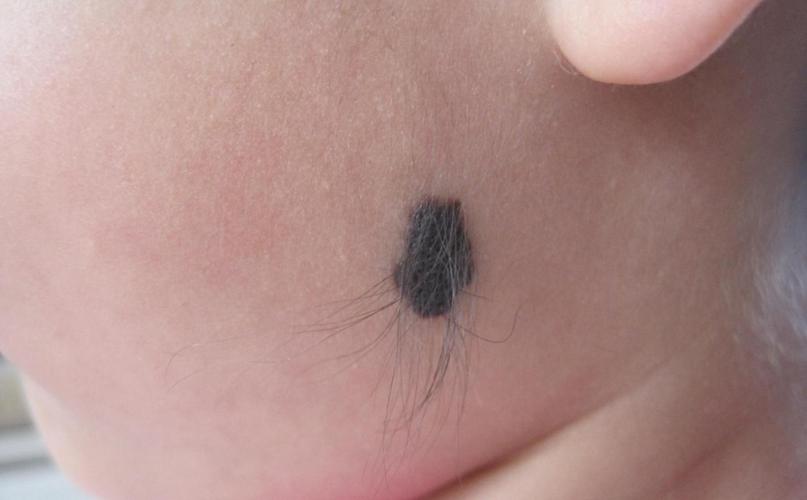 新生儿出生就带黑痣,是先天印记还是健康预警?-第2张图片-郑州医学网 新生儿出生就带黑痣,是先天印记还是健康预警?-第2张图片-郑州医学网