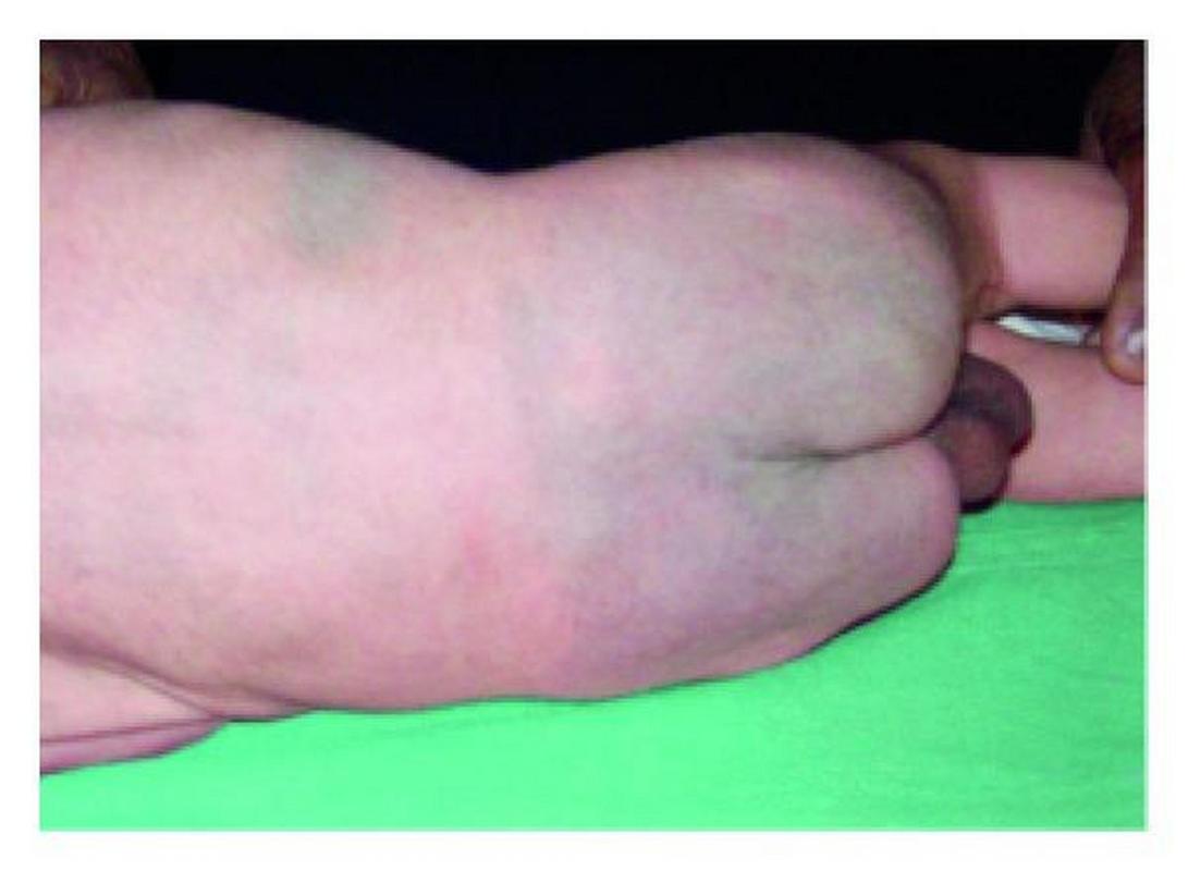 新生儿出生时身上有淤青正常吗？这些图片背后的原因是什么？-第1张图片-郑州医学网