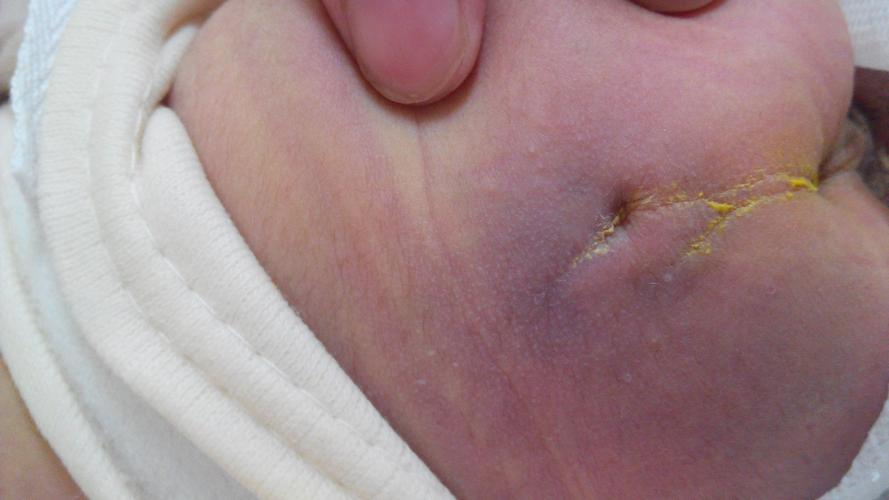 新生儿出生时身上有淤青正常吗？这些图片背后的原因是什么？-第3张图片-郑州医学网