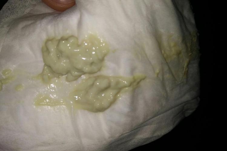 怀孕期间出现凝乳块状白带是正常现象吗？会对胎儿有影响吗？-第1张图片-郑州医学网