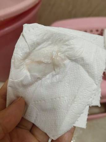 怀孕期间出现凝乳块状白带是正常现象吗？会对胎儿有影响吗？-第2张图片-郑州医学网