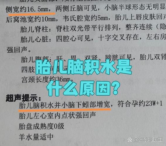 孕期胎儿脑积水如何治疗？有哪些安全有效的干预措施？-第3张图片-郑州医学网