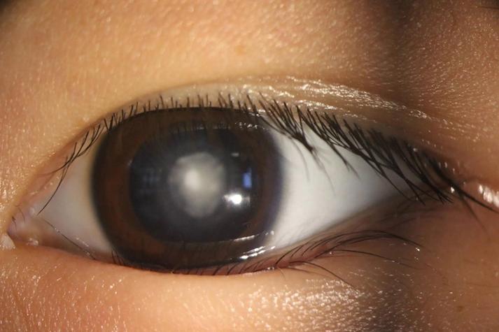 新生儿眼睛白眼球发灰是正常现象还是异常信号？需警惕哪些潜在健康问题？-第1张图片-郑州医学网