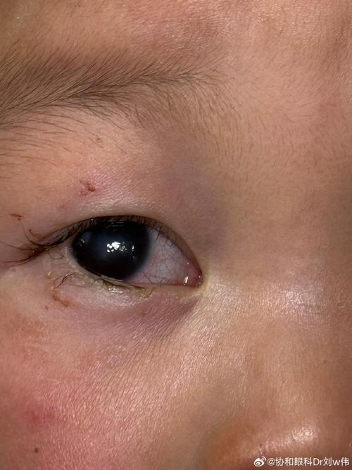 新生儿眼睛白眼球发灰是正常现象还是异常信号？需警惕哪些潜在健康问题？-第2张图片-郑州医学网