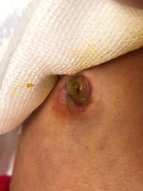 新生儿脐带未脱落且有脓性分泌物是感染了吗？如何正确处理？-第1张图片-郑州医学网