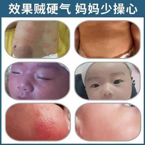 凡士林真的会伤害新生儿皮肤吗？家长该如何正确使用？-第2张图片-郑州医学网