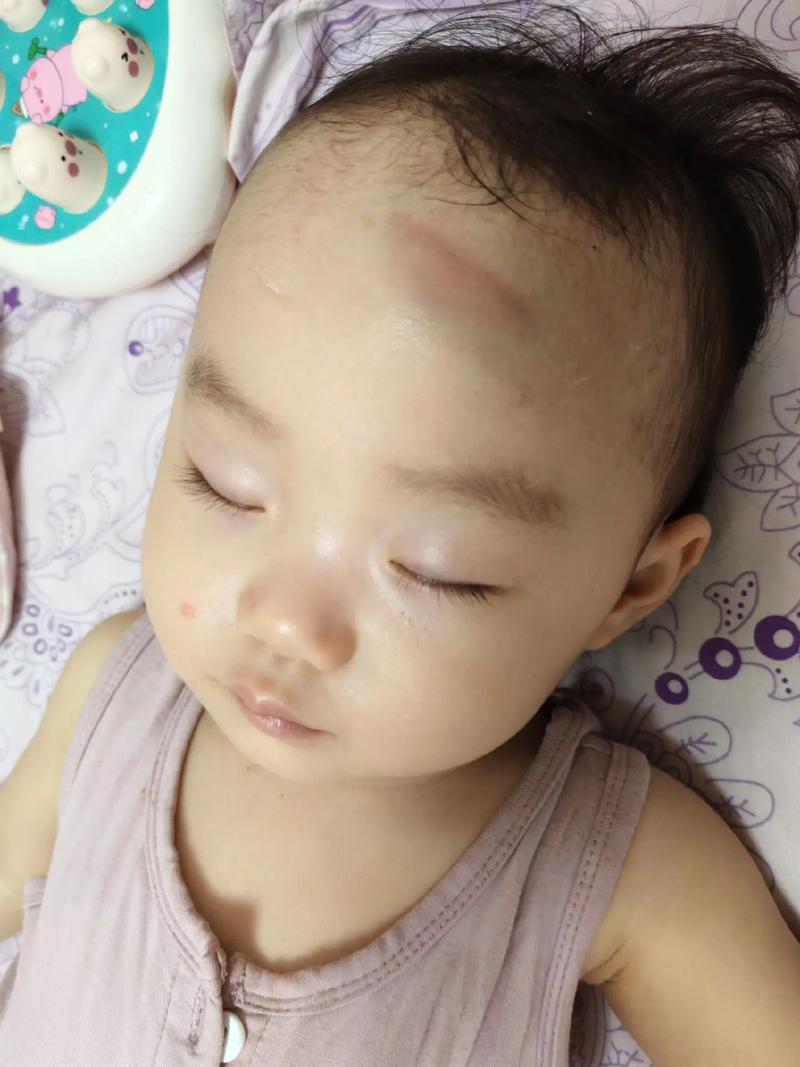 新生儿胳膊肘撞到脑袋后，家长该如何观察异常并及时应对？-第1张图片-郑州医学网