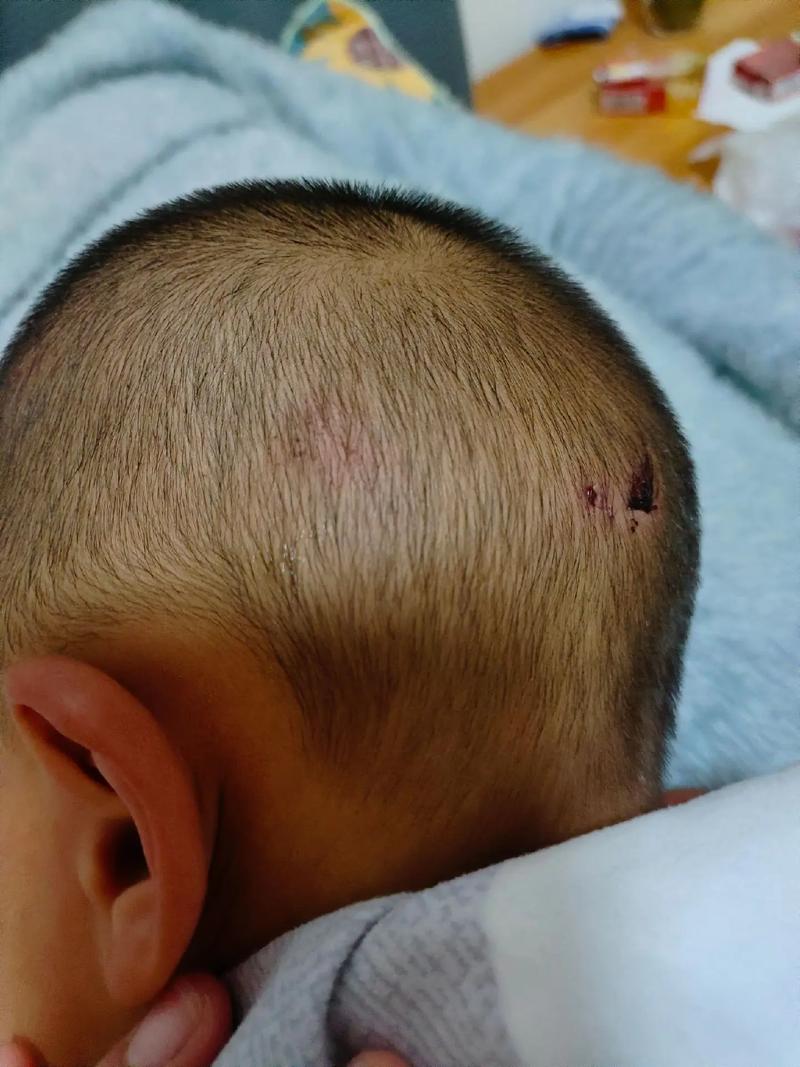 新生儿胳膊肘撞到脑袋后，家长该如何观察异常并及时应对？-第2张图片-郑州医学网