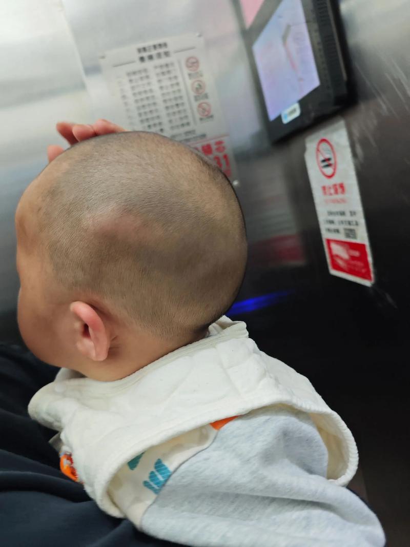 新生儿胳膊肘撞到脑袋后，家长该如何观察异常并及时应对？-第3张图片-郑州医学网