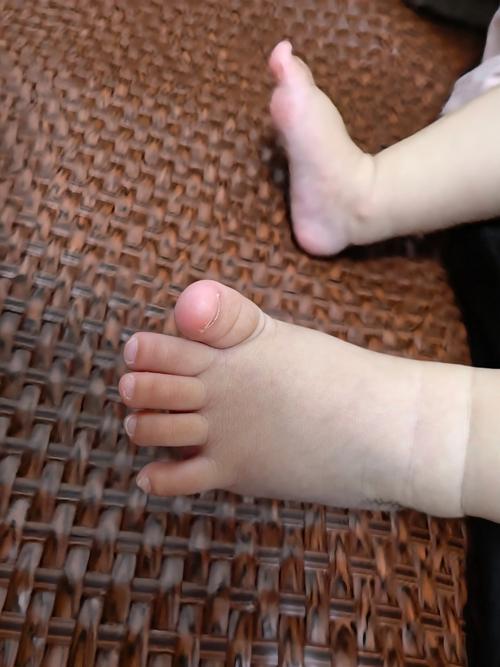 新生儿脚大拇指上翘是发育异常还是正常现象？需要干预吗？-第1张图片-郑州医学网