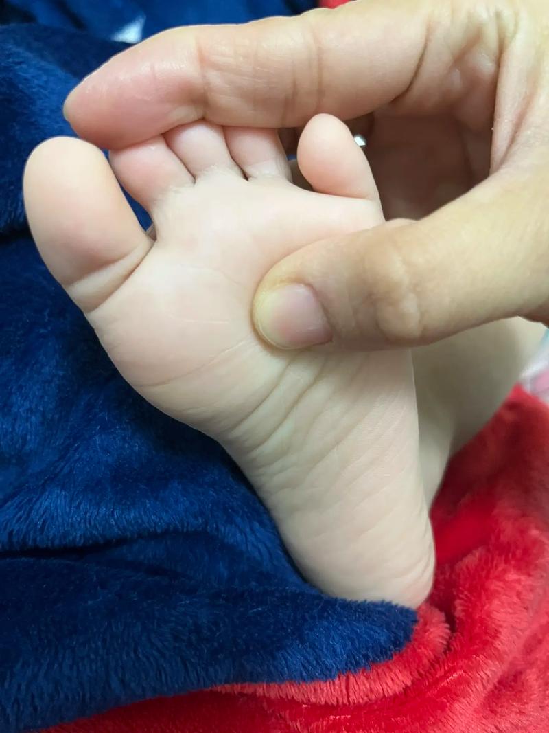 新生儿脚大拇指上翘是发育异常还是正常现象？需要干预吗？-第3张图片-郑州医学网