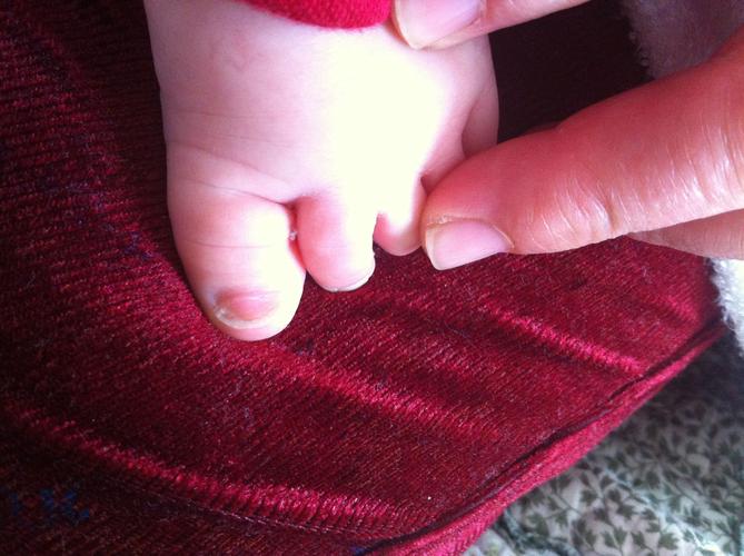 新生儿脚大拇指上翘是发育异常还是正常现象？需要干预吗？-第2张图片-郑州医学网