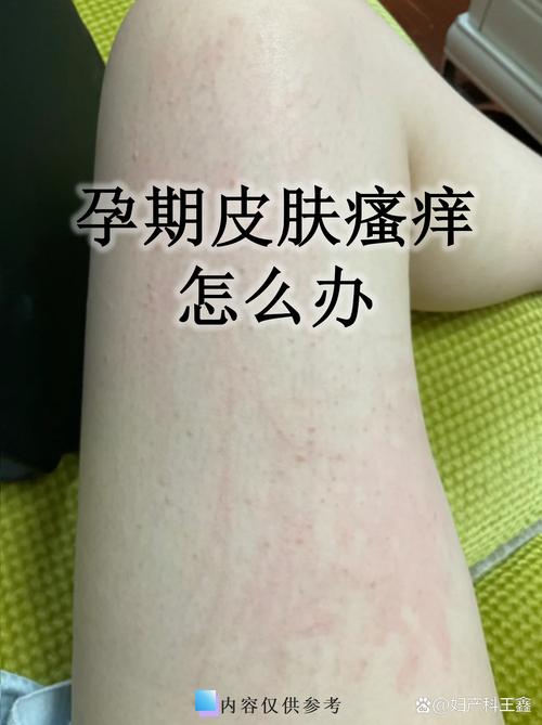 孕期身上痒别大意！是皮肤干燥还是妊娠期肝胆疾病在作祟？-第3张图片-郑州医学网