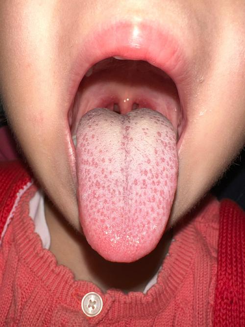 新生儿重舌初症状图片有哪些典型表现？如何辨别与其他口腔异常的区别？-第1张图片-郑州医学网