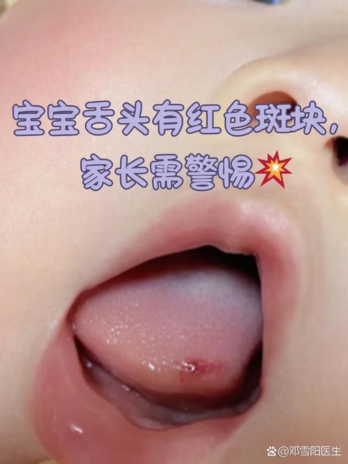 新生儿重舌初症状图片有哪些典型表现？如何辨别与其他口腔异常的区别？-第3张图片-郑州医学网