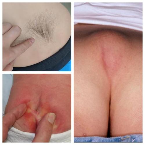 新生儿屁眼后的小坑是正常生理结构吗？需要特别护理或担心异常吗？-第1张图片-郑州医学网