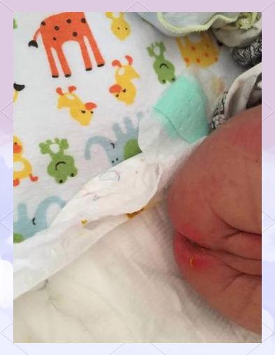 新生儿屁眼后的小坑是正常生理结构吗？需要特别护理或担心异常吗？-第2张图片-郑州医学网