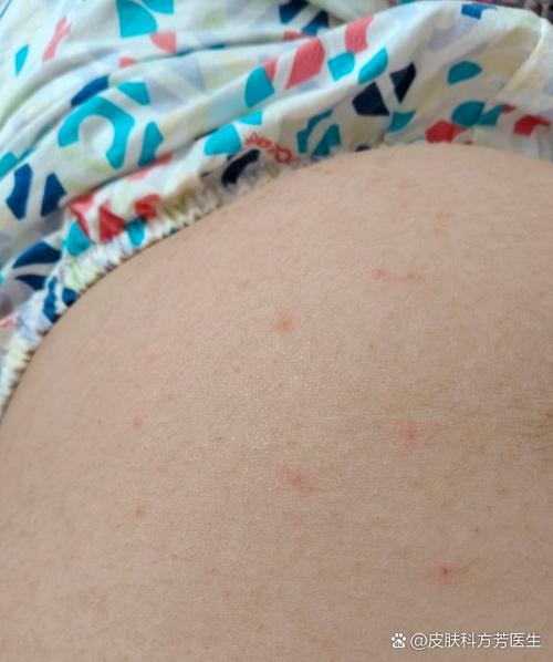 孕期肚子上起小红点还痒，是妊娠特有反应还是皮肤问题？-第1张图片-郑州医学网