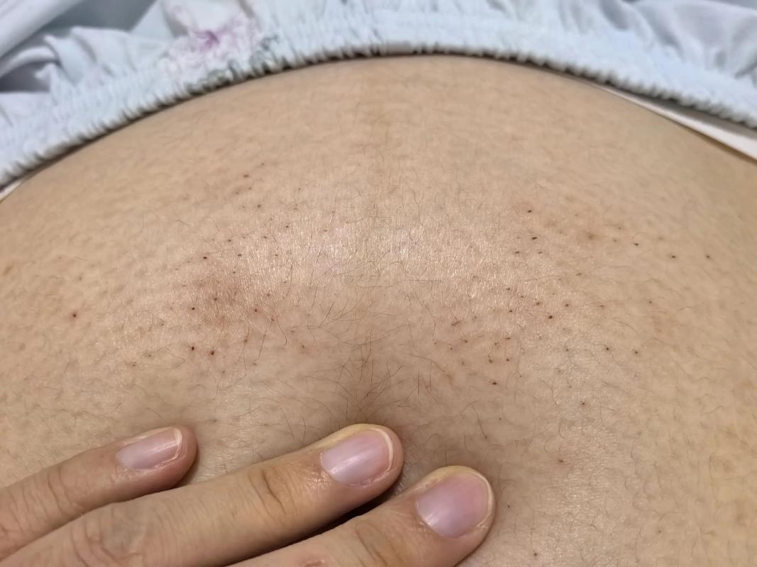 孕期肚子上起小红点还痒，是妊娠特有反应还是皮肤问题？-第2张图片-郑州医学网