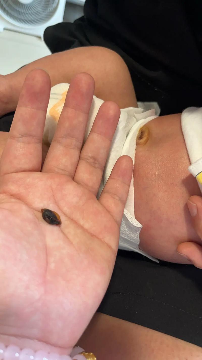 新生儿肚脐脱落过程中会感到疼痛吗？家长该如何正确护理避免不适？-第1张图片-郑州医学网